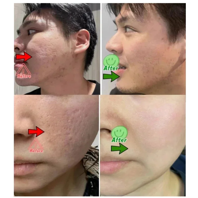 Krim Pembersih Pori Asam Salis - Skincare Salicylic Acid ulasan dan harga