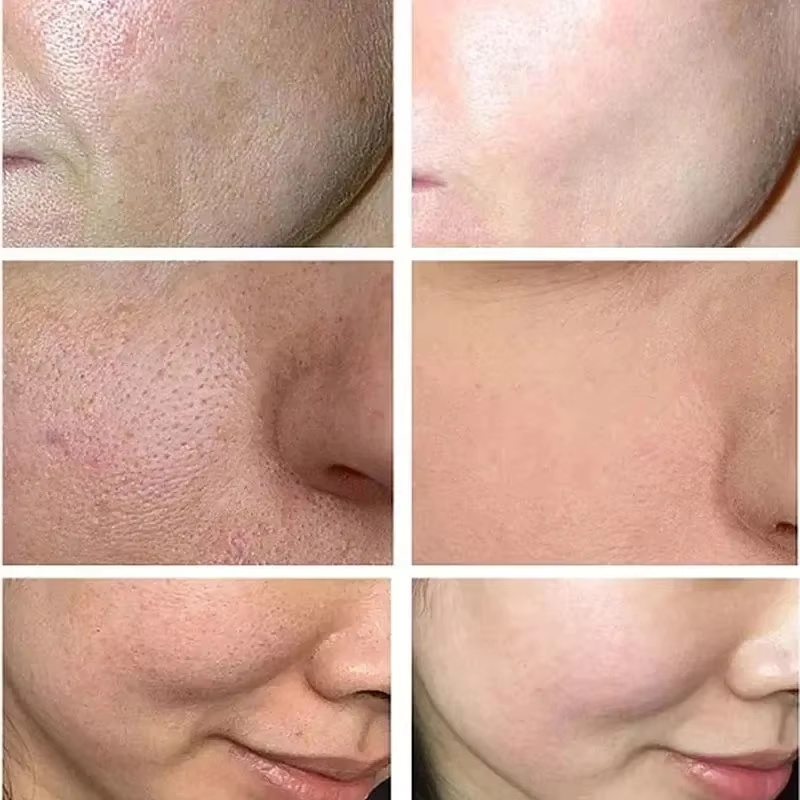 Krim Pengecil Pori Asam Salisi - Skincare Salicylic Acid ulasan dan harga